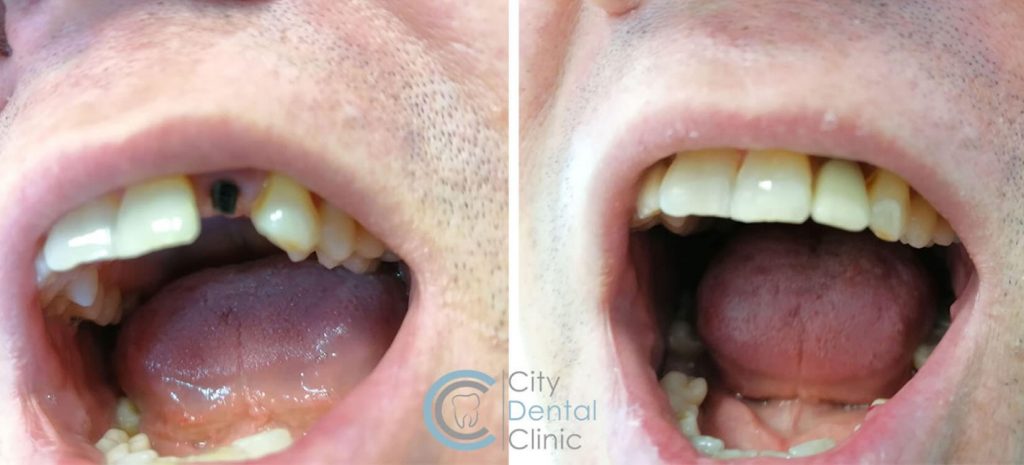 zubné implantáty pred a po